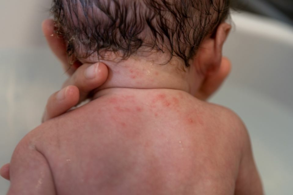 背中の乳児湿疹
