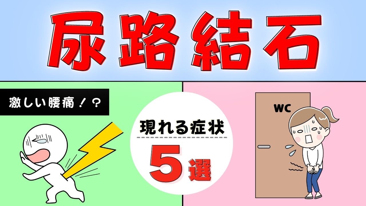 尿路結石症のすべて 尿路結石は夏場にご注意 十分な飲水・生活習慣改善を - 日本経済新聞