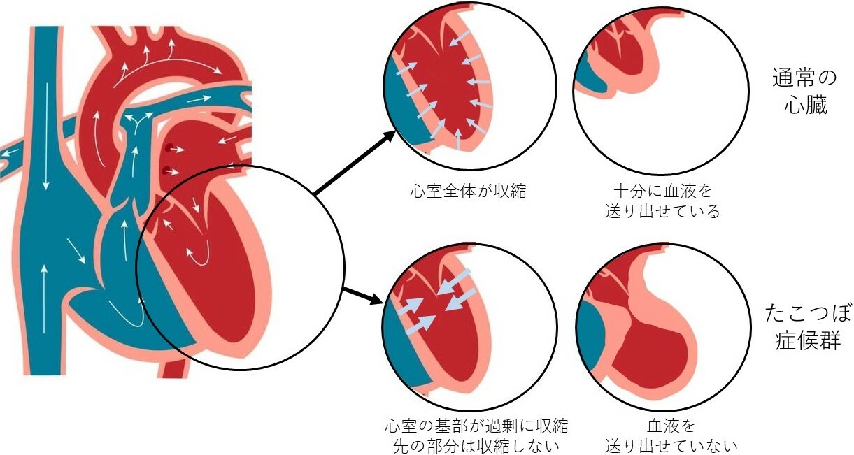 たこつぼ症候群のイメージ　　　　　　　　　　　　　　　　　