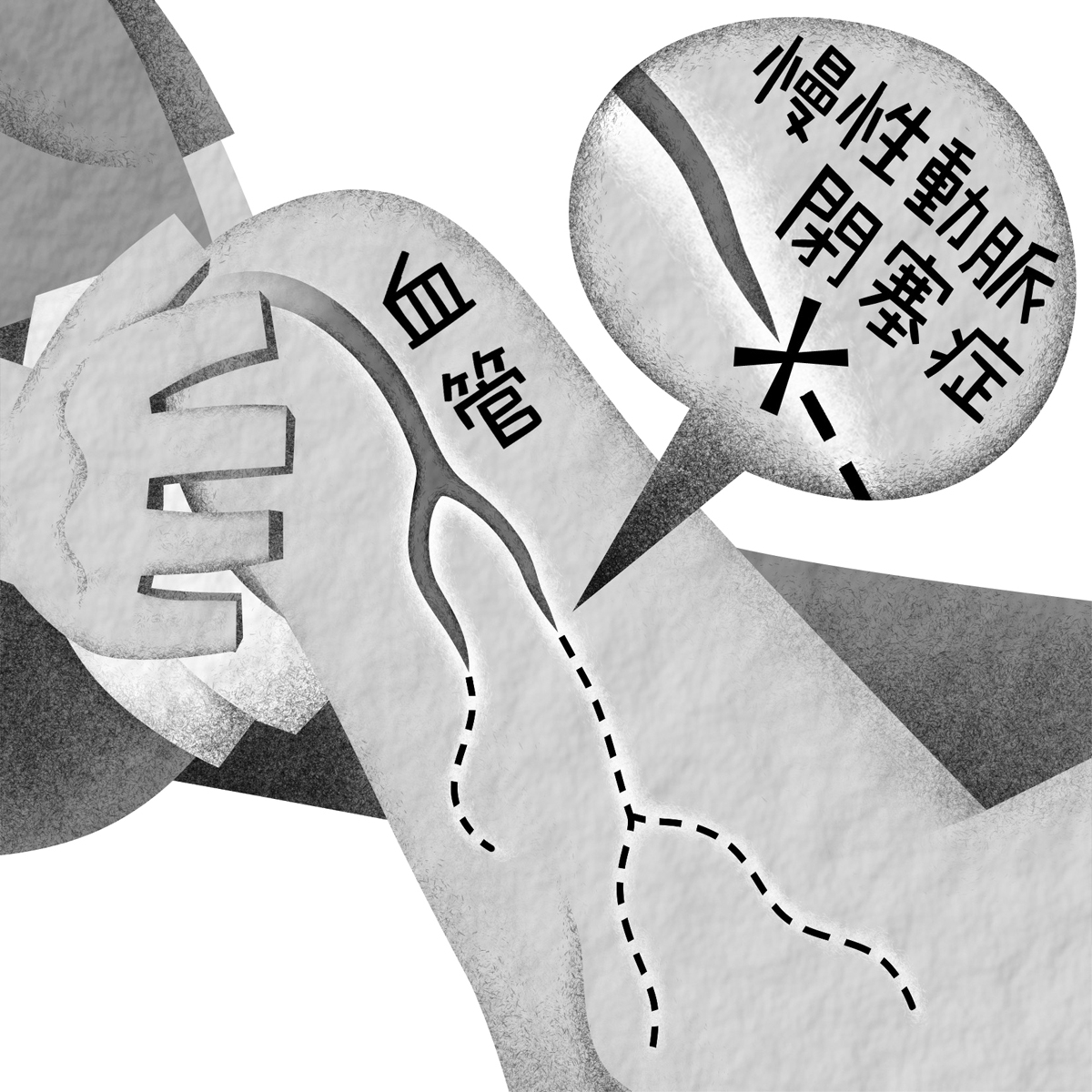 日本初「慢性動脈閉塞症」の遺伝子治療薬が保険適用承認へ