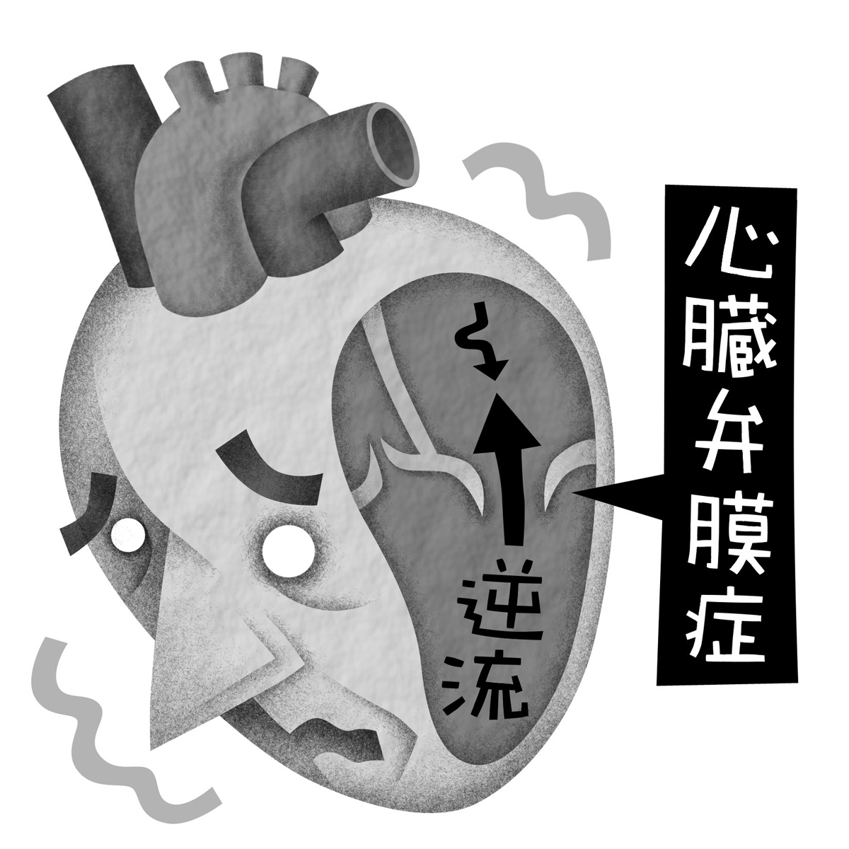 働き盛りの人の心臓弁膜症に手術法「3D-MICS」が普及