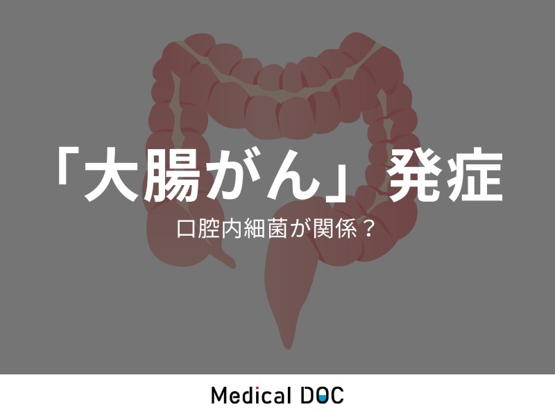「大腸がん」発症に“口腔内細菌”が産生する物質が関係していた！ 東大病院らが発表（Medical DOC） - Yahoo!ニュース