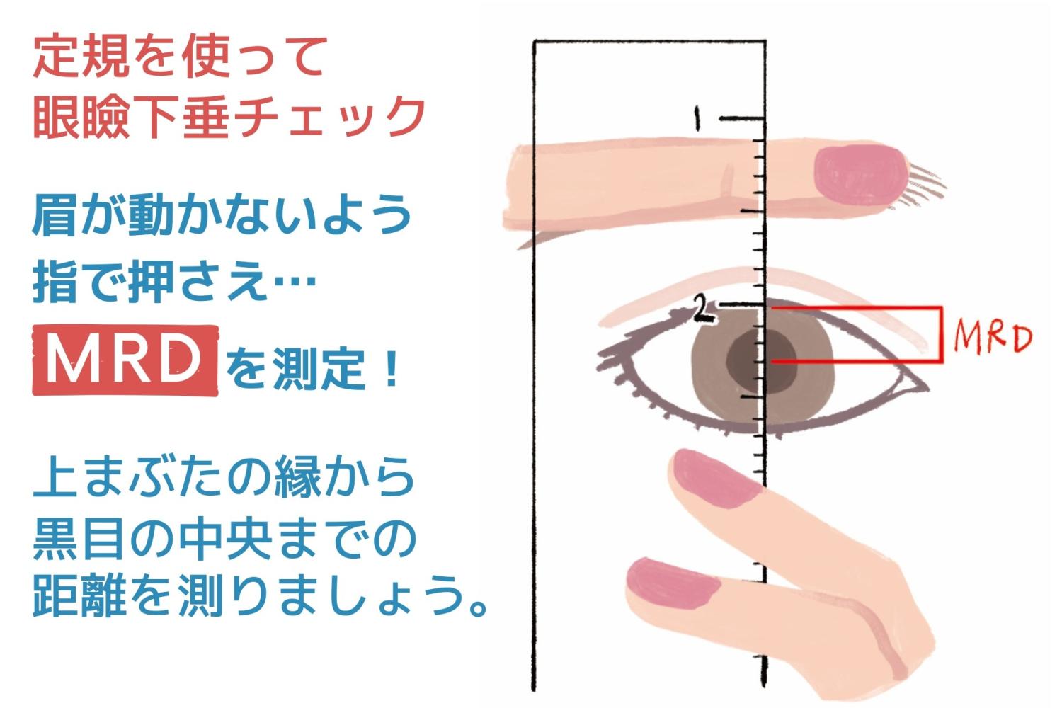 40代、50代・どうする？眼瞼下垂 】急増中の眼瞼下垂（がんけんかすい 