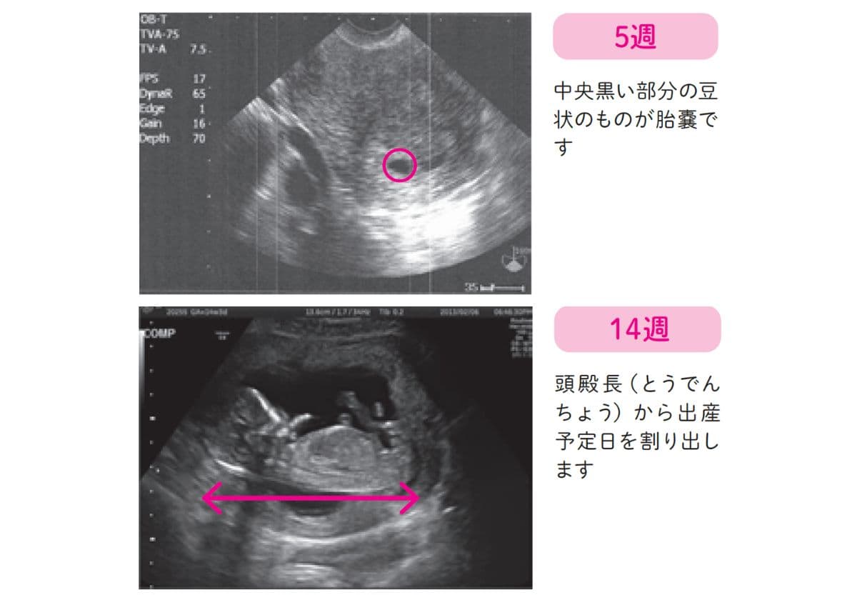 産婦人科医が教える「エコー写真」の詳しい見かた（nobico（のびこ）） - Yahoo!ニュース