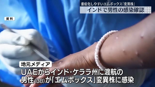 重症化しやすい「エムポックス」変異株 インドで男性の感染確認