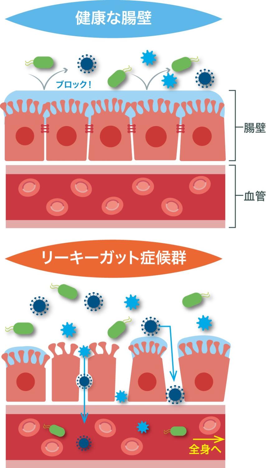 注目のあの病気は「お腹のカビ」が原因!?【なんとなく不調、その
