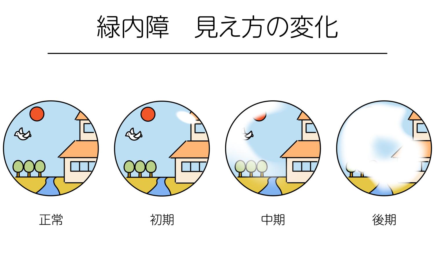 中途失明の原因、第1位は緑内障。早期発見するには？【40代、50