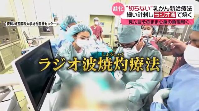 ラジオ波焼灼療法の施術の様子