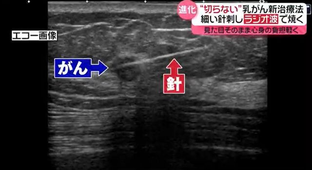 治療前後のエコー画像比較