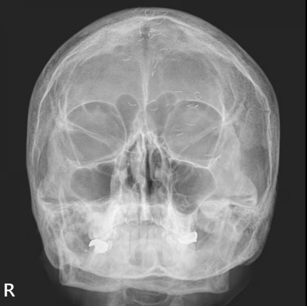 寄生虫?電子チップ?…韓国で公開された「頭痛患者のX線写真 寄生虫?電子チップ?…韓国で公開された「頭痛患者のX線写真