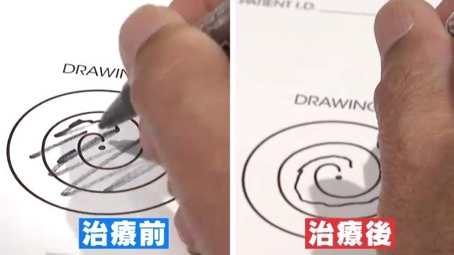 高度な医療サービスを受けるため日本へ　外国人の需要が高まる「医療ツーリズム」　超音波を脳に照射する最新治療を受ける中国人男性に密着　【チャント!大石が聞く】
