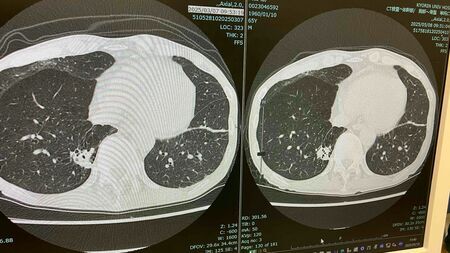 「腫瘍は不変」抗がん剤治療は奏功も、がんサバイバーに訪れる予期せぬ体の異変とは？
