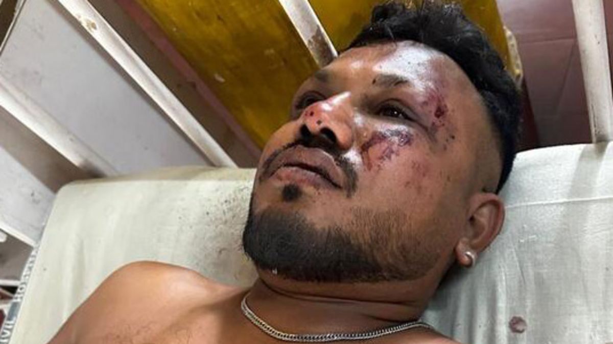 インド航空機事故でただ一人生還し、治療を受けているビシュワシュ・クマル・ラメシュさん