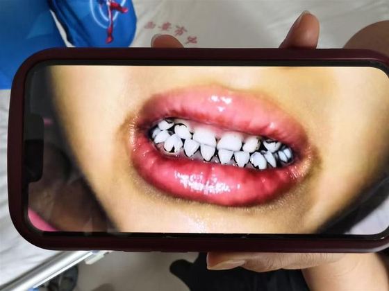突然髪が抜け歯が黒くなる…中国で幼稚園児の集団鉛中毒発生