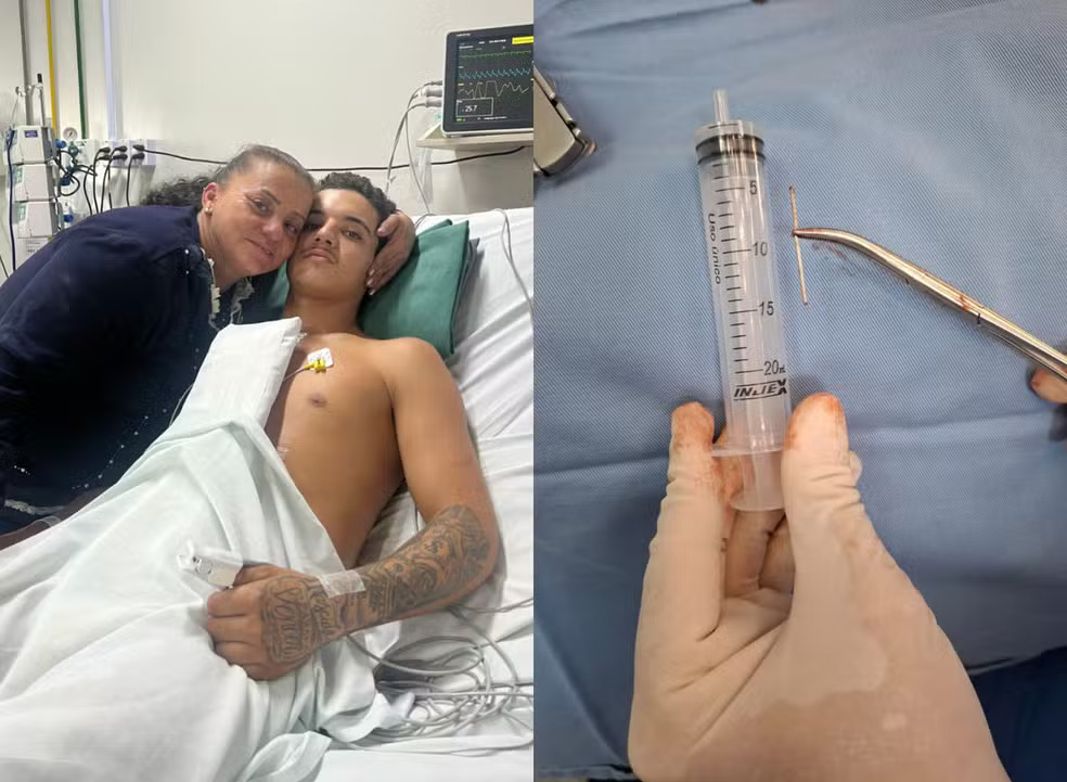 釘打ち機事故で胸部に釘が刺さったブラジルの17歳作業員エデルソンさんの術後の様子
