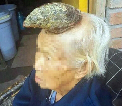 頭の「角」腫瘍を自ら切った98歳の中国人女性…出血で応急手術