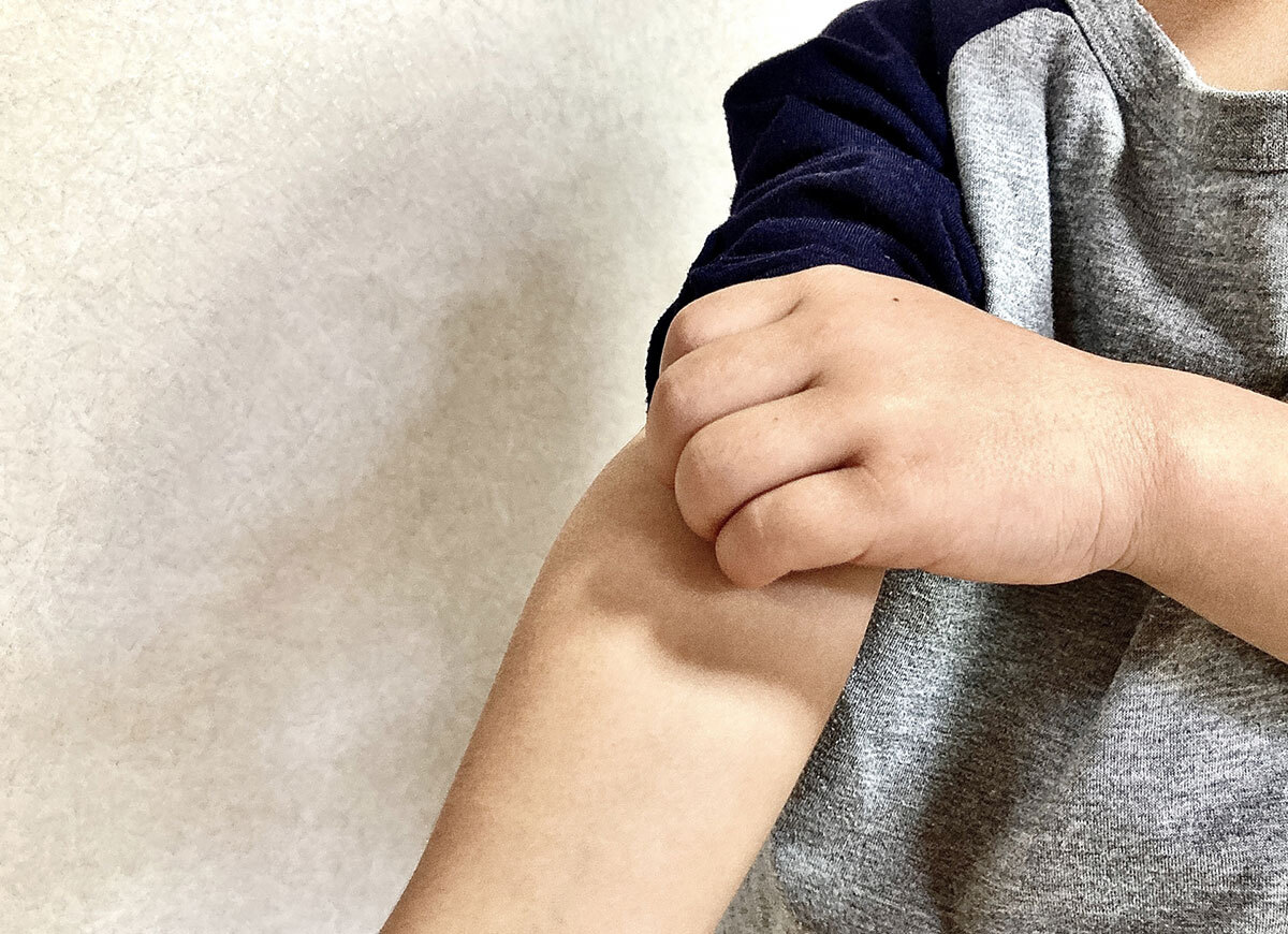 アトピー性皮膚炎で炎症を起こした子どもの腕と、肌ケアをする様子。重症化するとQOLに影響。