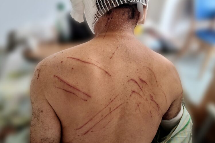 クマに襲われ、背中に痛ましい傷跡が残る被害男性の様子