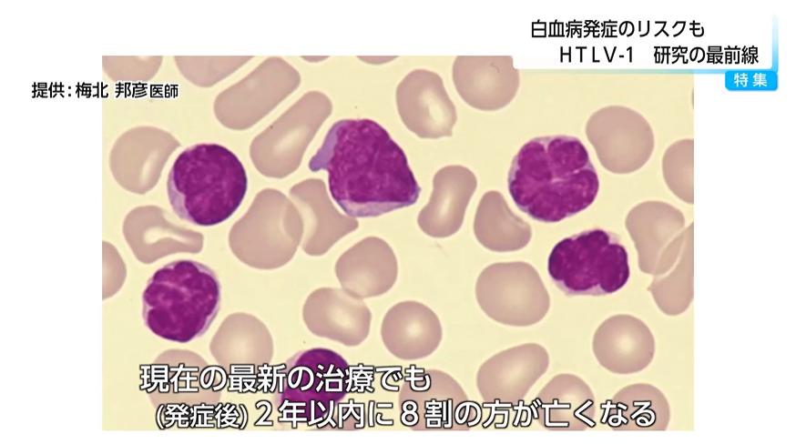 潜伏期間は約50年　白血病や神経難病のリスクとなるウイルス「HTLV-1」　国内は65万人が感染　うち半分は九州に集中　医師は検査の重要性を訴える（FNNプライムオンライン） - Yahoo!ニュース