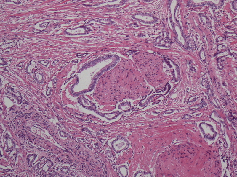 膵臓がんの病理組織標本の一例。がん細胞が組織の間をぬうようにバラバラと広がる。著者撮影。