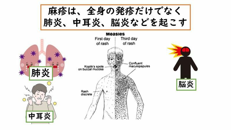 Journal of Infectious Diseases. 2004;189(Supplement_1):S4-S16.の図より筆者作成