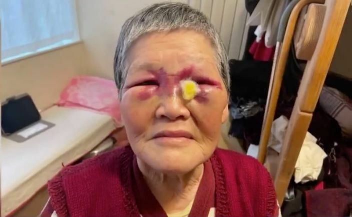 Xiaoさんは、目からの出血が続き、PTSDにも苦しんでいるという。写真：news.yahoo.com