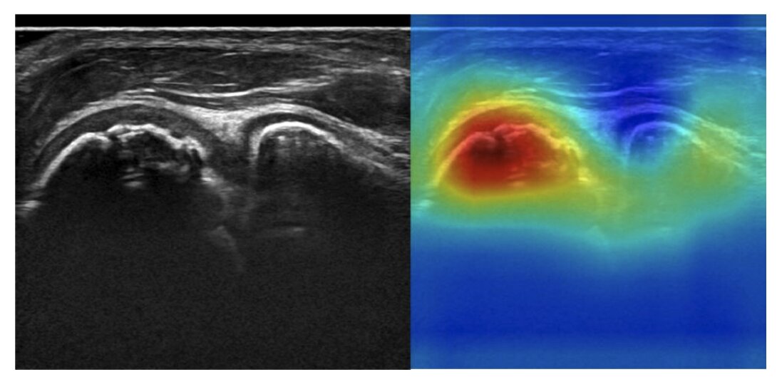 AIによる超音波検査画像の野球肘の検出。左の赤く表示された部位が野球肘。京都府立医大のリリースより