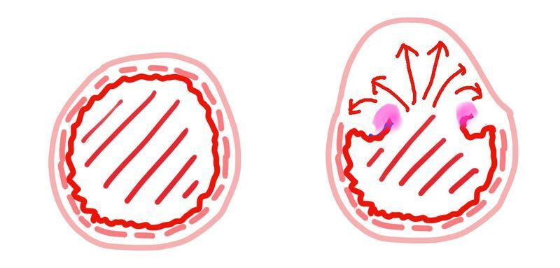 内側の亀裂から、壁の中に血液が流れ込む (筆者作成)
