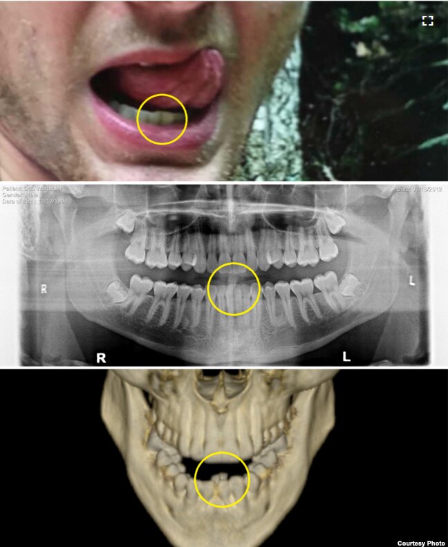 VOAが公開したワームビアさんの写真。上の2枚ではきれいに並んでいる歯のうち2本が、最下段のスキャン画像では口の内側に大きく移動している