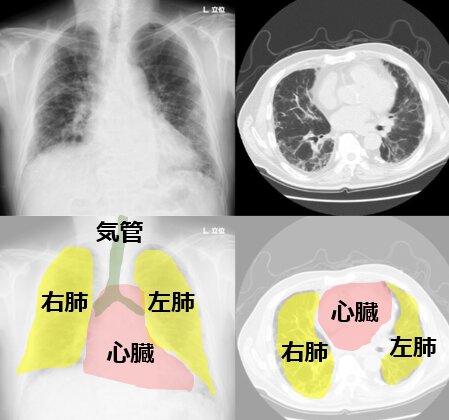 新型コロナの患者さんの胸部レントゲン写真（左）と胸部CT写真（右）（患者さんの許可を得ています）