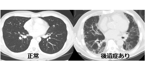 正常の胸部CT写真（左）と後遺症を残したCOVID-19患者さんの胸部CT写真（右）