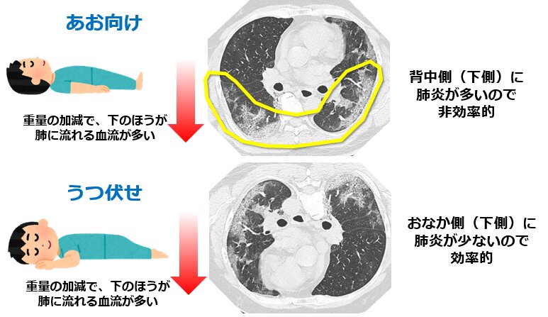 図2.　新型コロナにおけるうつ伏せ寝の効果：肺のCT画像で白くなっている部分が肺炎（筆者作成、胸部CTは患者承諾を得て自験例を掲載）