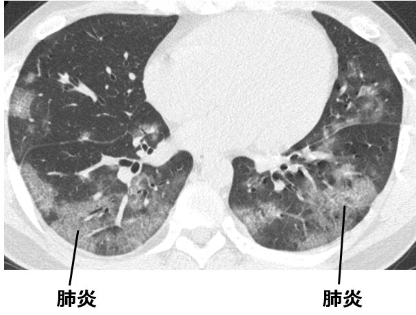 図3. オミクロン株による中等症IIの新型コロナ（両肺に広範囲の肺炎がみられる：患者さんの同意を得て掲載）