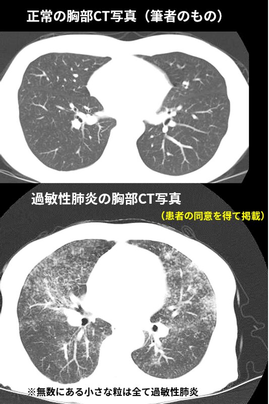 図3. 過敏性肺炎の胸部CT写真（患者の同意を得て掲載）