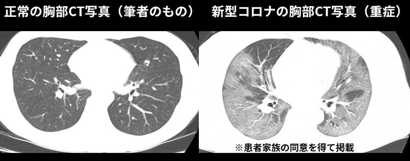 図3. 第4～5波でよくみられた両肺が白くなった新型コロナ（患者家族の同意を得て掲載）
