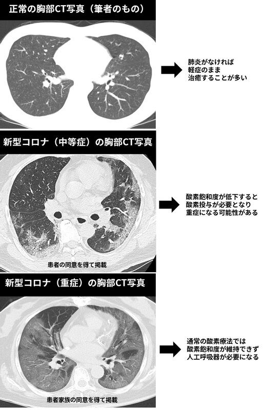図3. 肺炎の有無について（筆者作成）