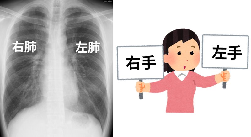 図1. 正常の胸部X線画像（胸部X線写真は筆者自身のもの）