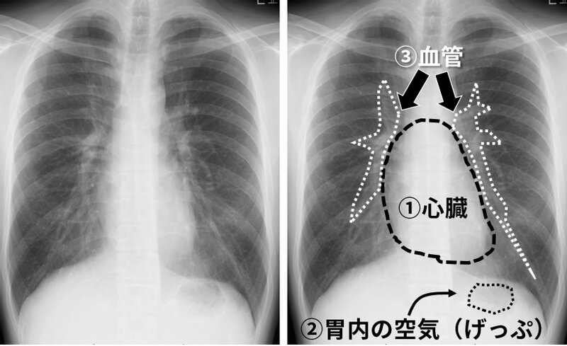 医師が患者から聞かれる、胸部X線写真の「コレなんですか？」 トップ３ 