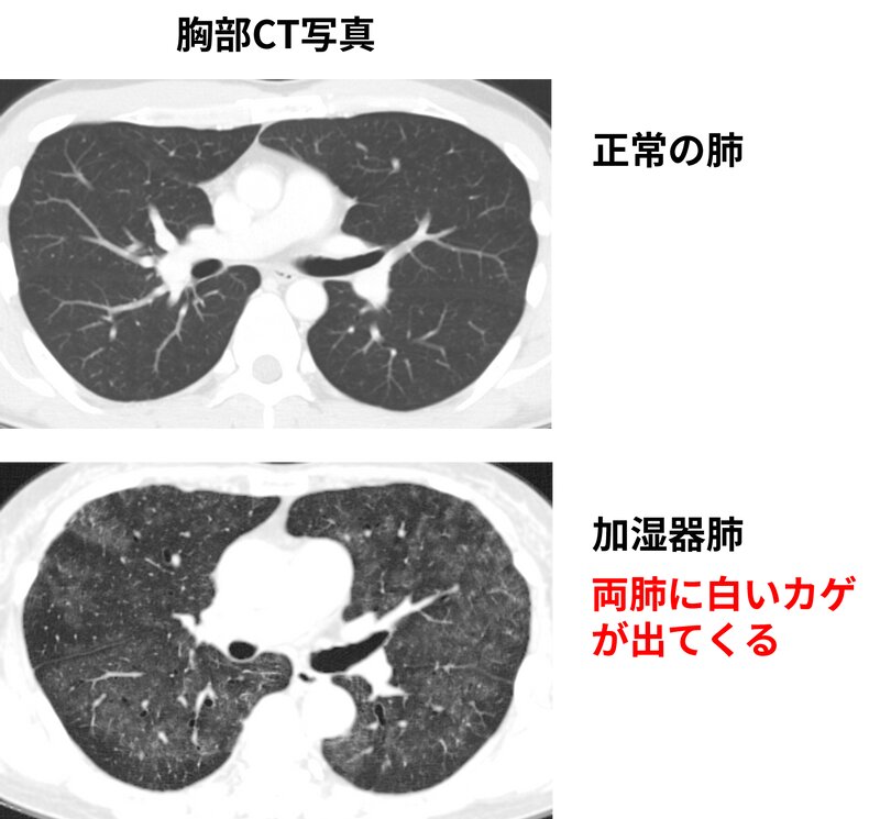 図4. 加湿器肺の胸部CT写真（患者様の同意を得て掲載、正常の肺は筆者のもの）