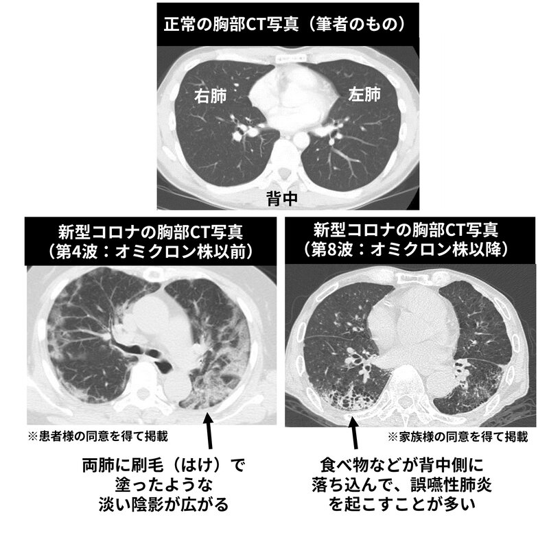図2. 新型コロナの肺炎の変遷（筆者作成）（患者様・家族様の同意を得て掲載）