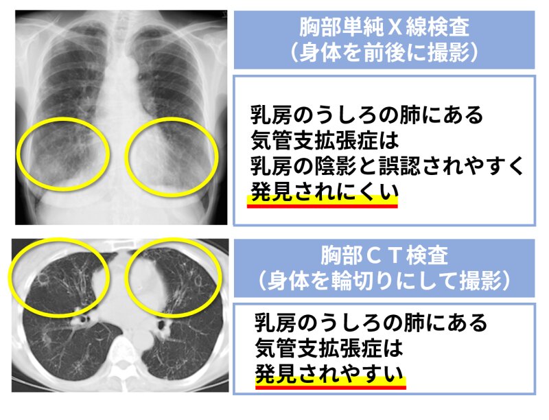 図２．胸部CT検査だと発見されやすい（患者様の同意を得て掲載）