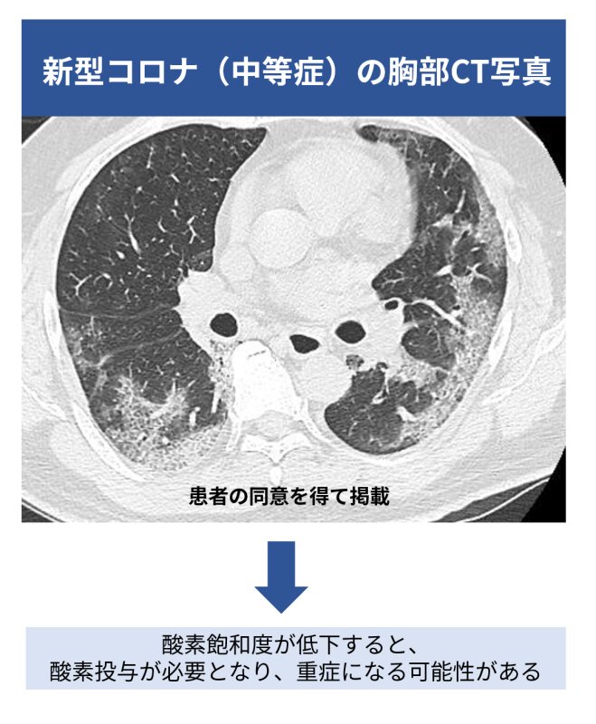 図２．新型コロナ性肺炎（白いところが肺炎、患者の同意を得て掲載）