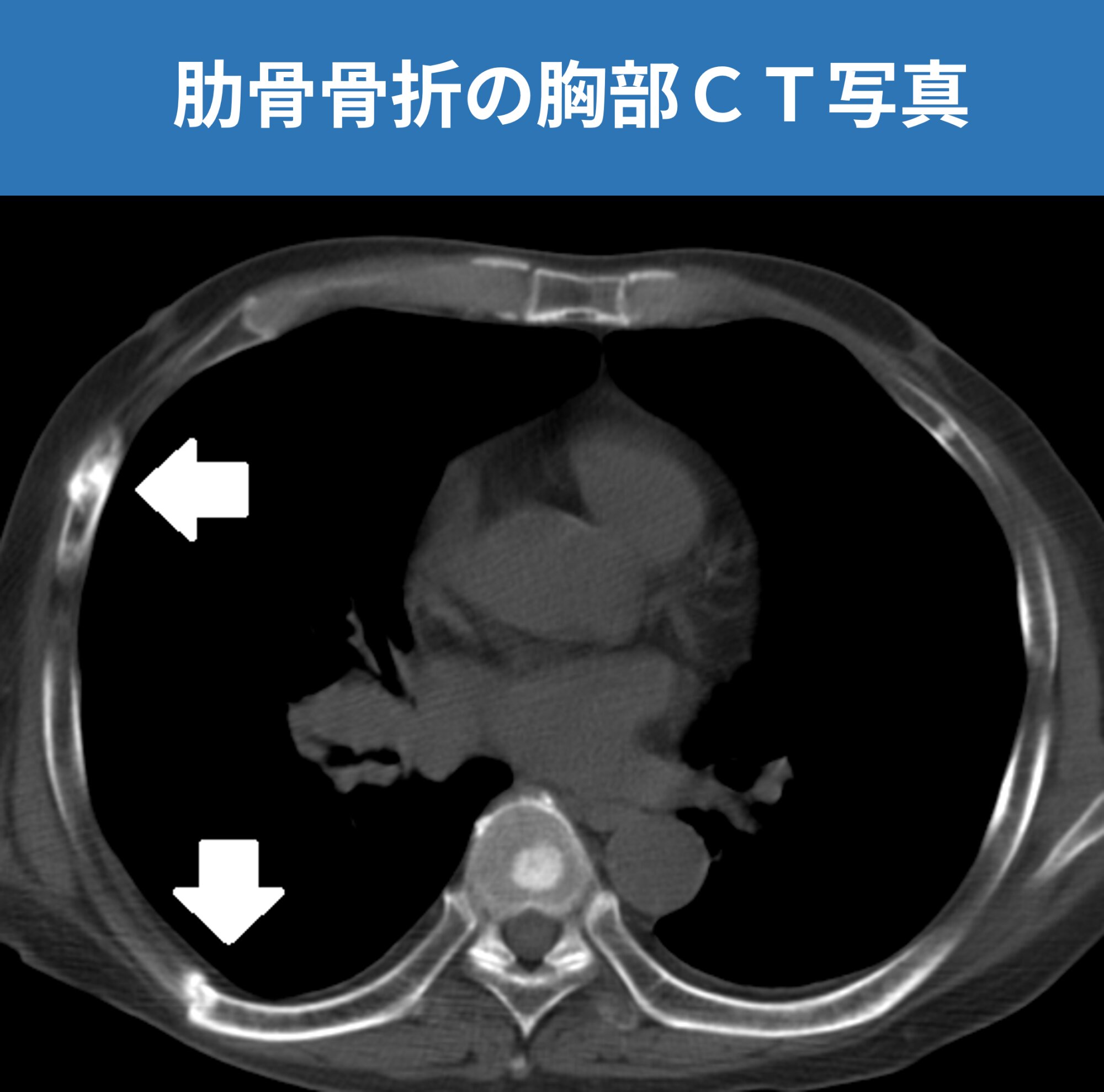 図２. 肋骨骨折の胸部ＣＴ写真（白い矢印が折れた肋骨、患者さんの同意を得て掲載）