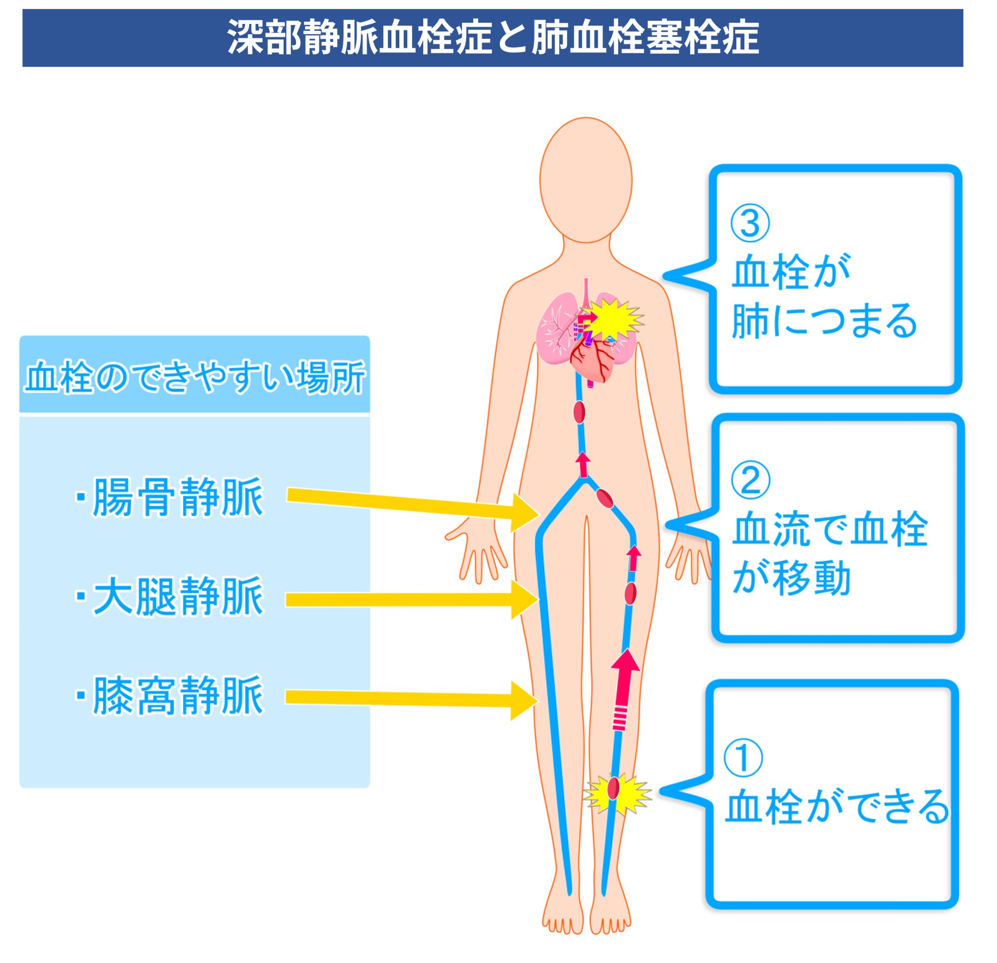 図１. 深部静脈血栓症（①）と肺血栓塞栓症（③）（イラストはイラストACより使用）