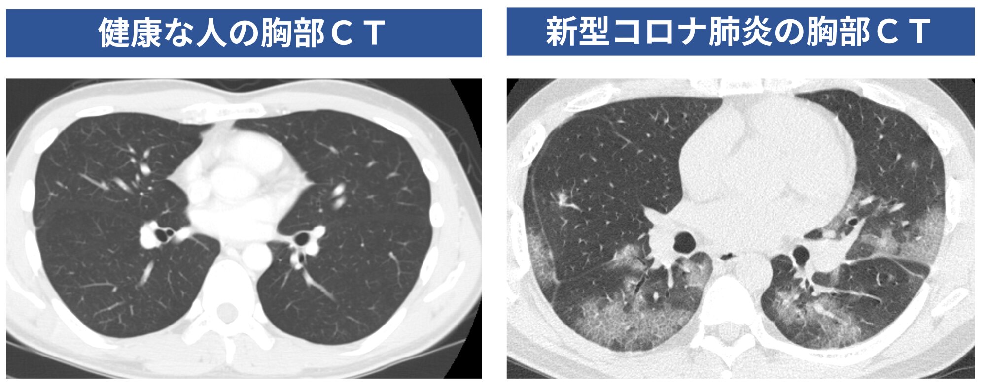 図１．健康な人（筆者自身のもの）の胸部CT写真と新型コロナ患者の胸部CT写真（患者の同意を得て掲載）