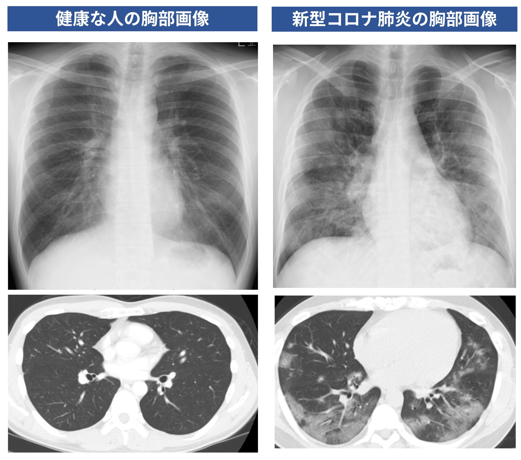 図２．健康な人（筆者自身）と新型コロナ患者（同意を得て掲載）の胸部画像検査（上：胸部単純Ｘ線写真、下：胸部単純ＣＴ写真）