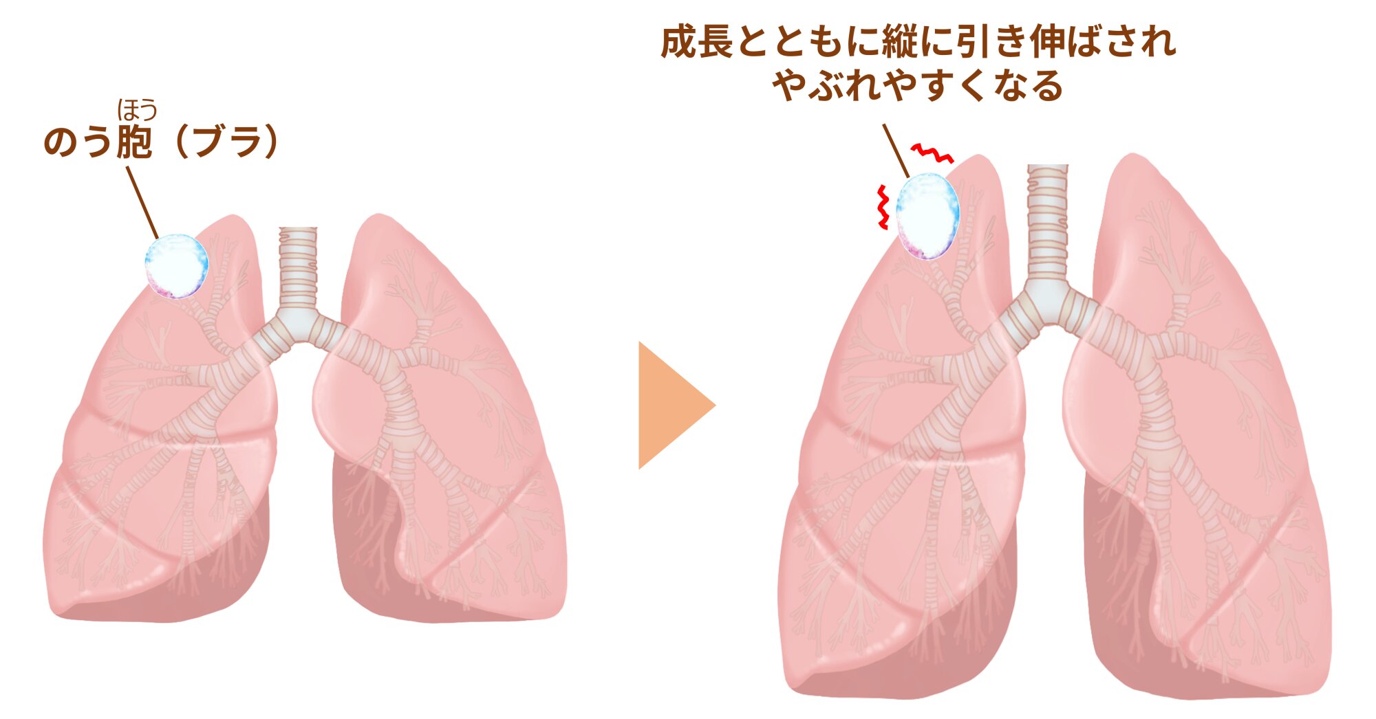 図２．肺にできたのう胞（ブラ）（筆者作成、イラストはイラストＡＣより使用）
