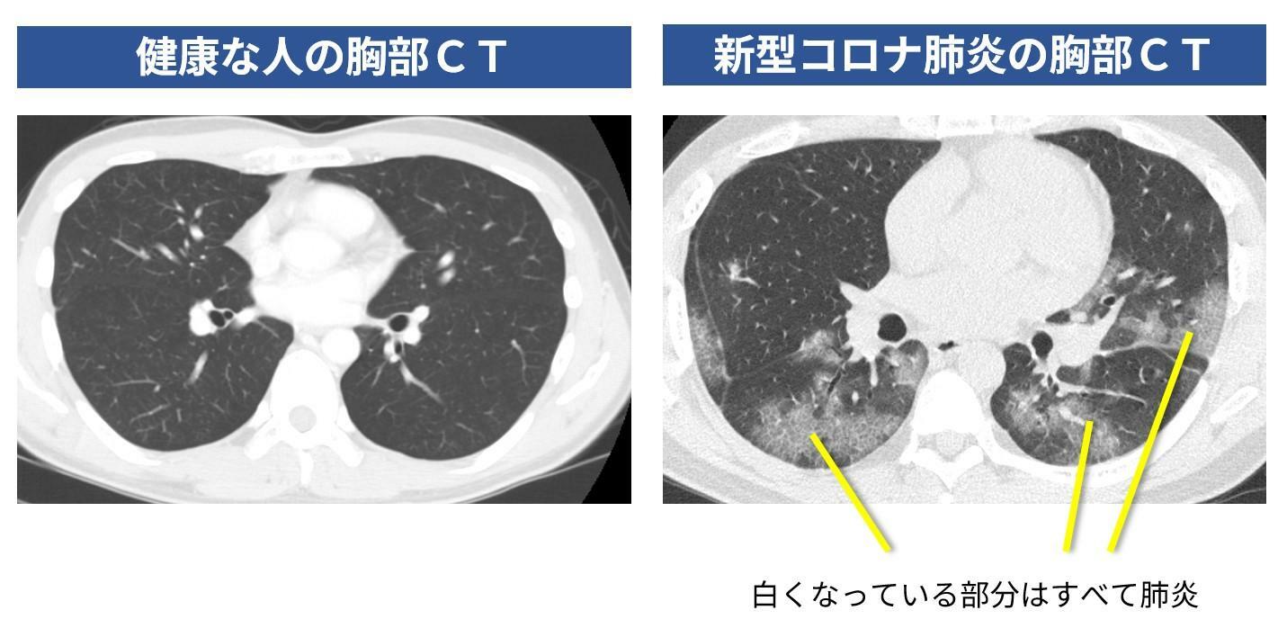 図２．健康な人の胸部CT（筆者自身のもの）と新型コロナ肺炎の胸部CT（患者様より同意を得て掲載）