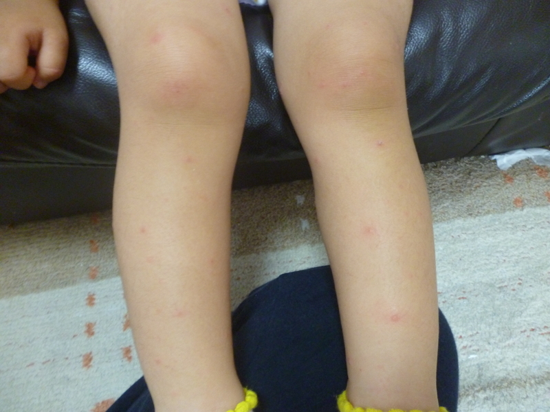 筆者の娘の足にみられた手足口病の皮疹（筆者撮影）