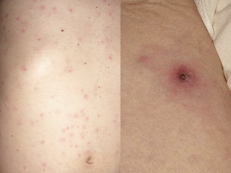 日本紅斑熱患者の皮疹（左）と痂皮（右）　山藤栄一郎医師（長崎大学 熱帯医学研究所）提供